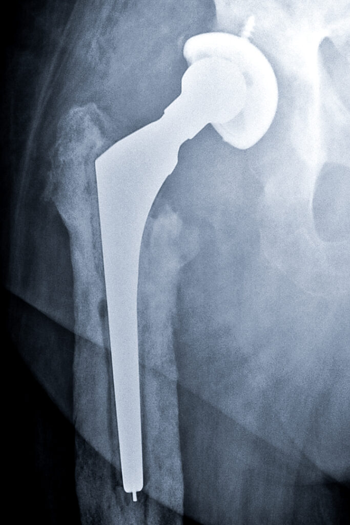 Infected Hip Replacement – ADAM SASSOON M.D., M.S.