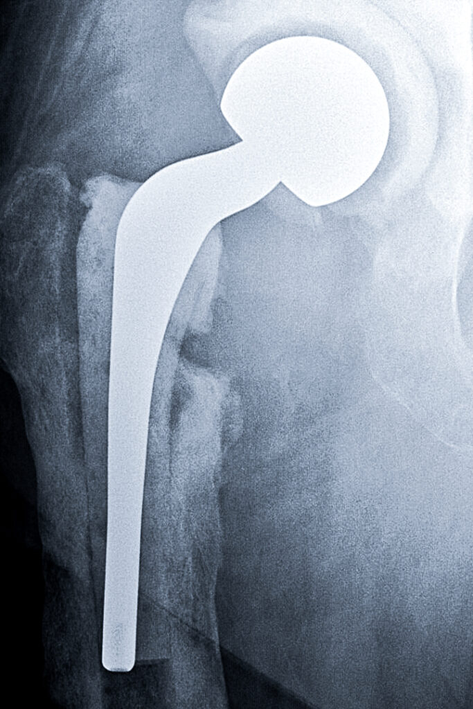 Infected Hip Replacement – ADAM SASSOON M.D., M.S.