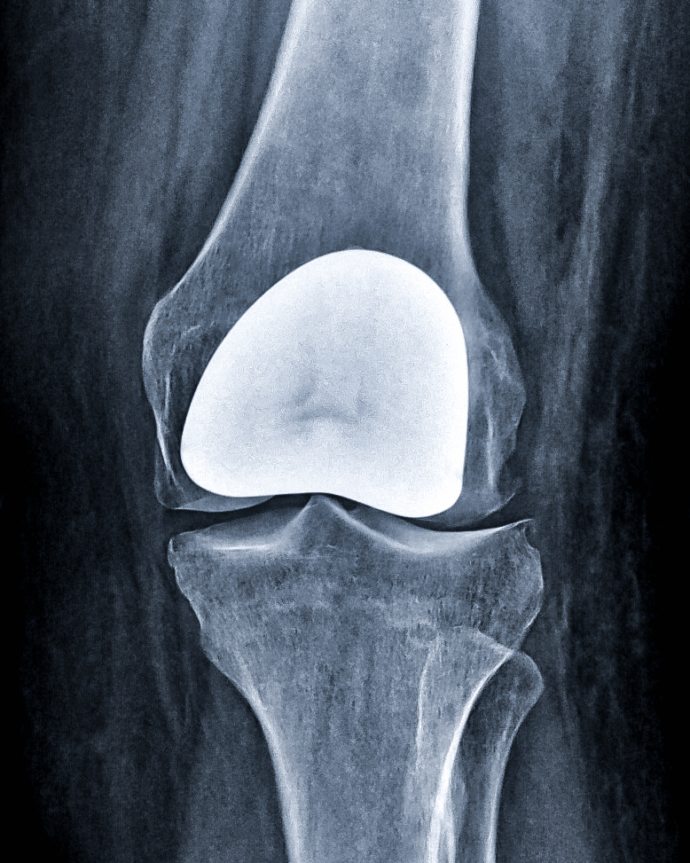 Patellofemoral Arthroplasty – ADAM SASSOON M.D., M.S.