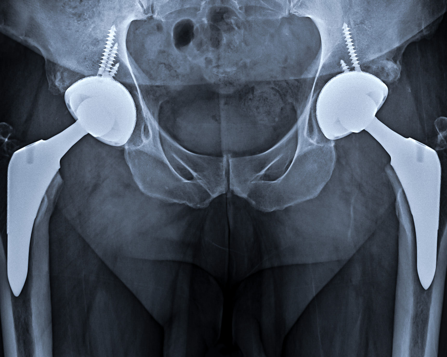 Total Hip Replacement Parts